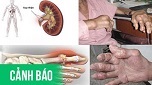 Đừng để bệnh Gout mới chớm đến khi tàn phá khớp mới chữa trị rồi hối hận cả đời